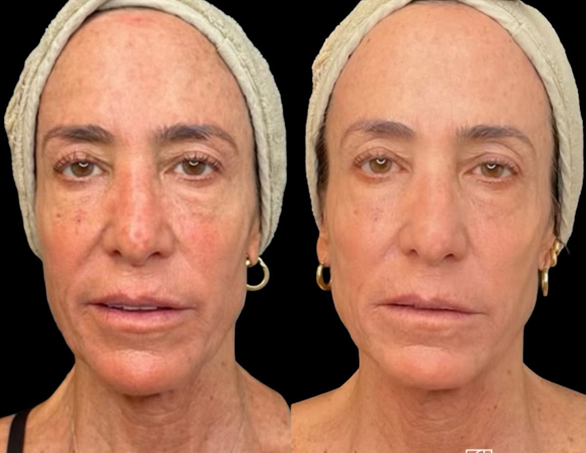 UltraClear® Before & After Gallery - Patient 280960 - Image 3