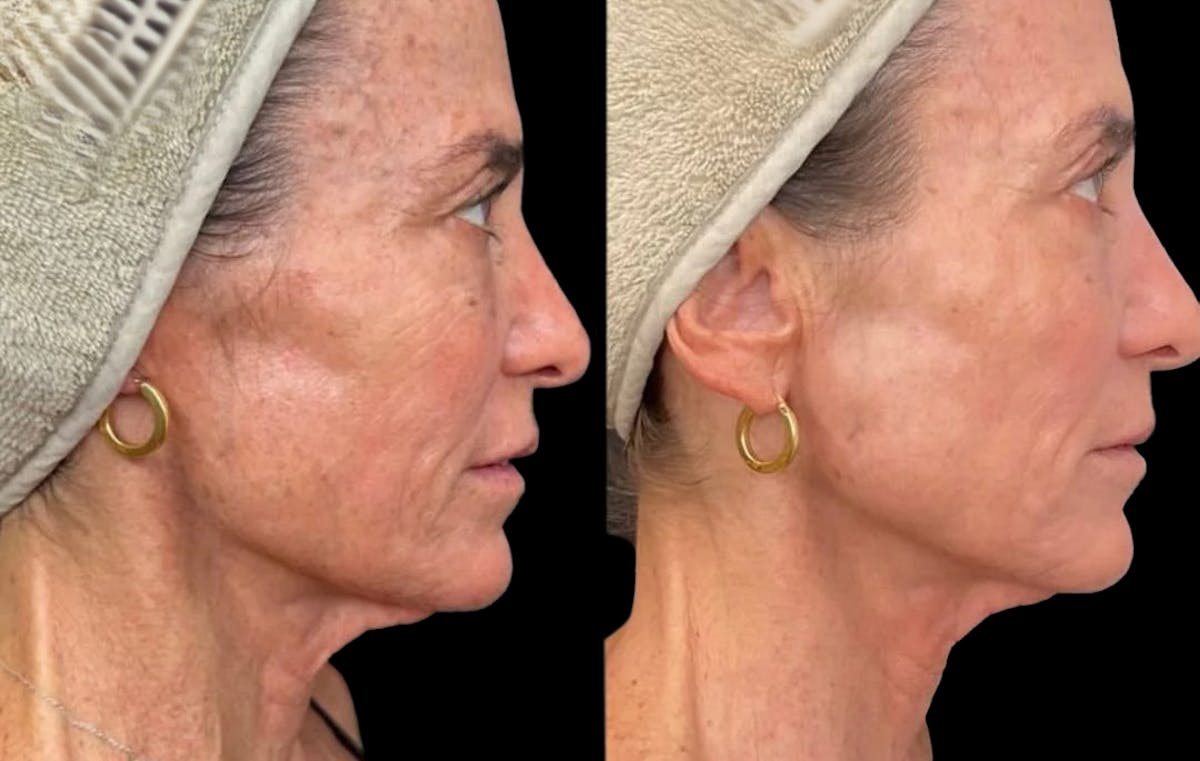 UltraClear® Before & After Gallery - Patient 280960 - Image 2