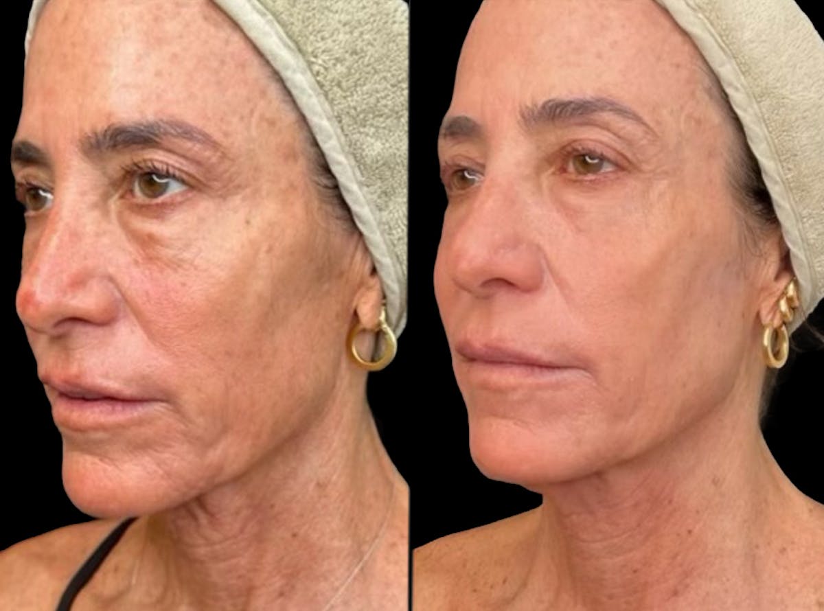 UltraClear® Before & After Gallery - Patient 280960 - Image 4