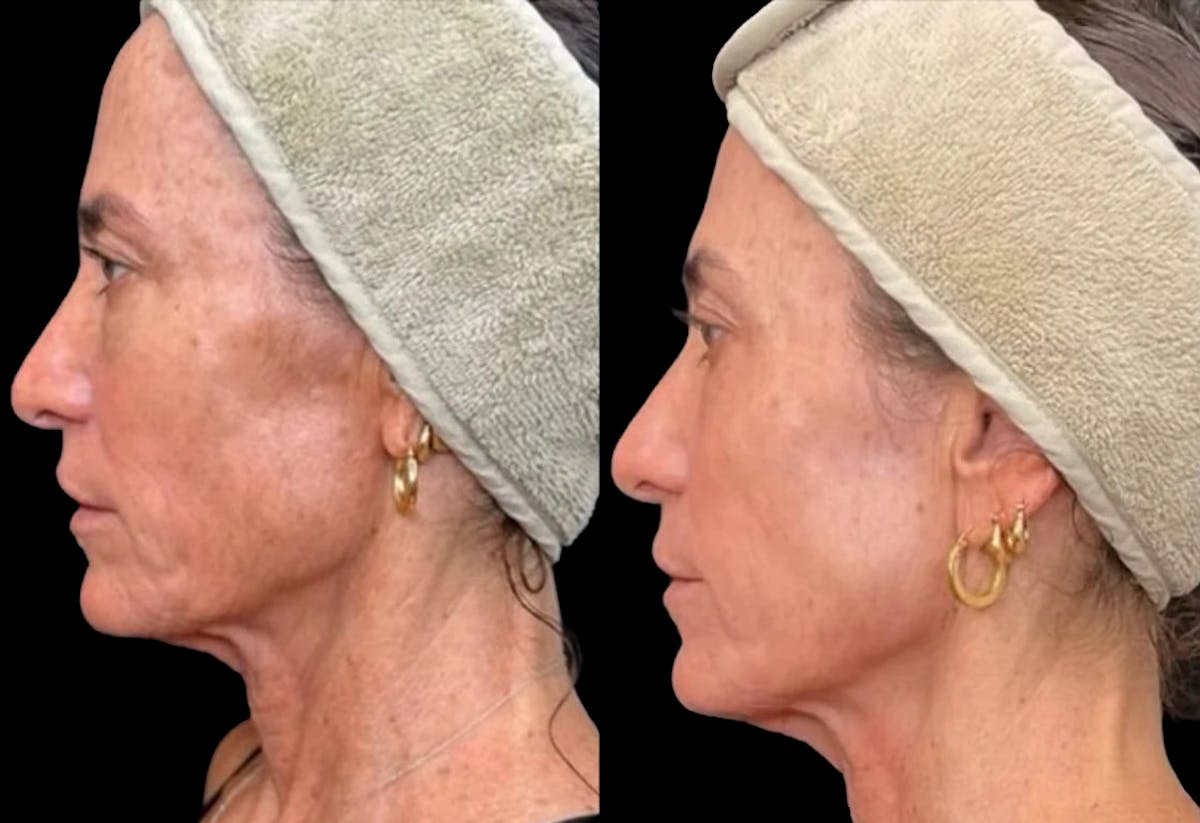 UltraClear® Before & After Gallery - Patient 280960 - Image 1