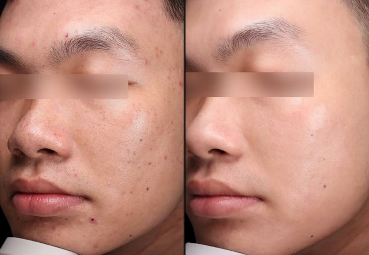 UltraClear® Before & After Gallery - Patient 384935 - Image 1