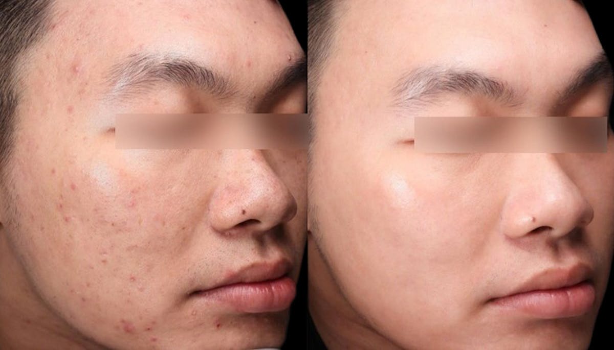 UltraClear® Before & After Gallery - Patient 384935 - Image 2