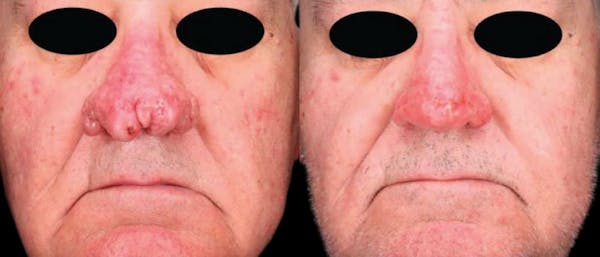 UltraClear® Before & After Gallery - Patient 311072 - Image 1