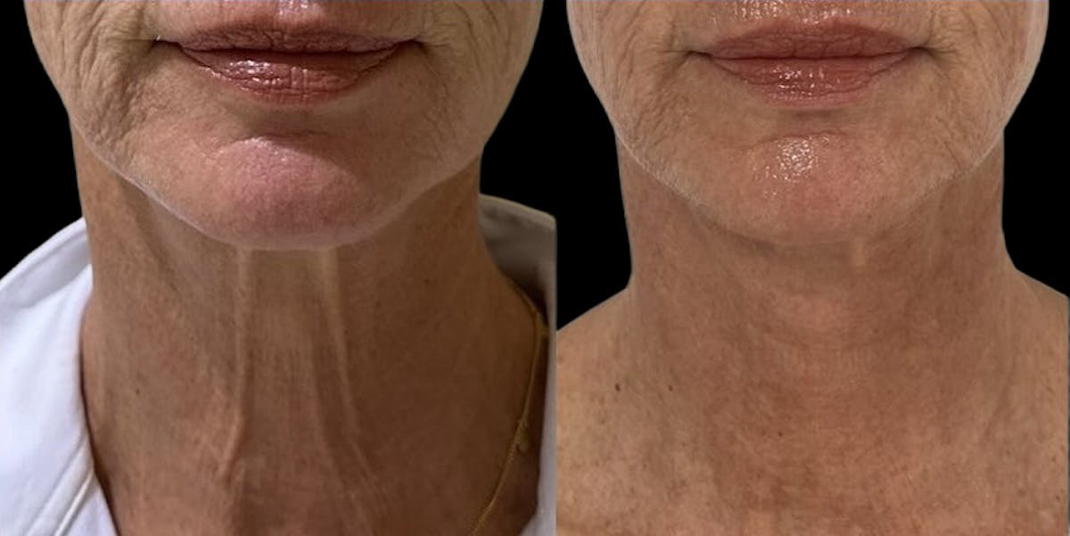 UltraClear® Before & After Gallery - Patient 416164 - Image 1