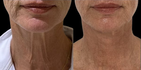 UltraClear® Before & After Gallery - Patient 416164 - Image 1