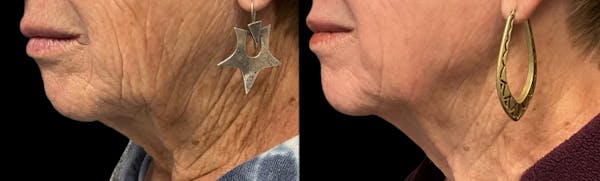 UltraClear® Before & After Gallery - Patient 322163 - Image 1