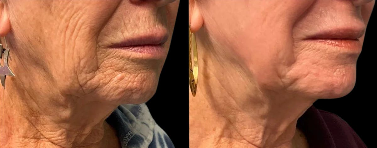 UltraClear® Before & After Gallery - Patient 322163 - Image 2