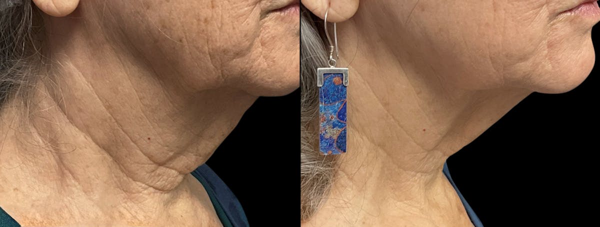 UltraClear® Before & After Gallery - Patient 205385 - Image 1