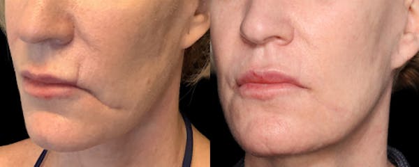 UltraClear® Before & After Gallery - Patient 130496 - Image 1