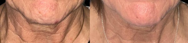 UltraClear® Before & After Gallery - Patient 140736 - Image 1