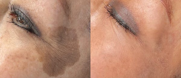 UltraClear® Before & After Gallery - Patient 346659 - Image 1