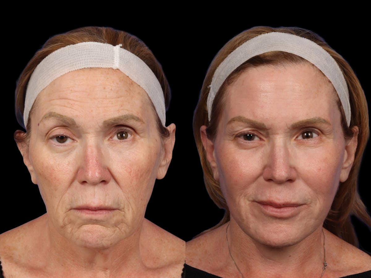 UltraClear® Before & After Gallery - Patient 106694 - Image 1