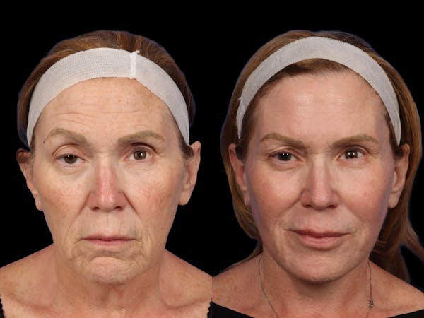 UltraClear® Before & After Gallery - Patient 106694 - Image 1