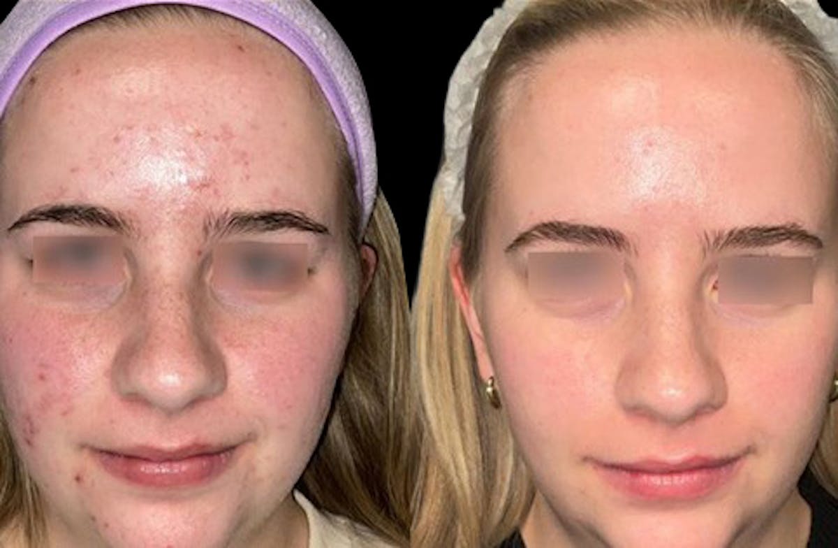 UltraClear® Before & After Gallery - Patient 112569 - Image 1