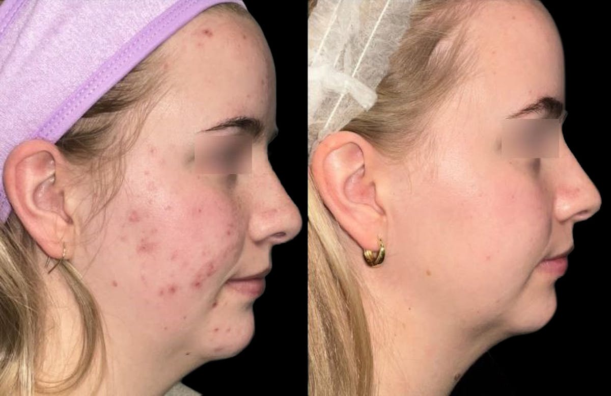 UltraClear® Before & After Gallery - Patient 112569 - Image 2