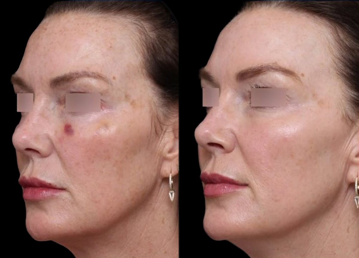 UltraClear® Before & After Gallery - Patient 211871 - Image 2