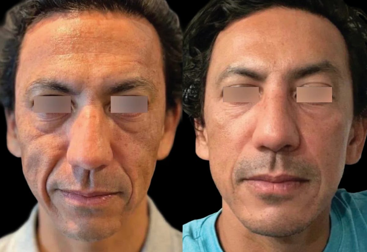 UltraClear® Before & After Gallery - Patient 171903 - Image 1