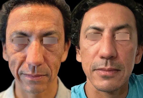 UltraClear® Before & After Gallery - Patient 171903 - Image 1