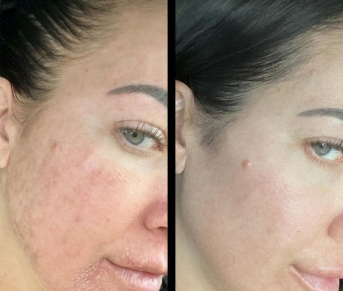 UltraClear® Before & After Gallery - Patient 205084 - Image 1