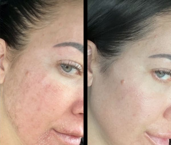 UltraClear® Before & After Gallery - Patient 205084 - Image 1