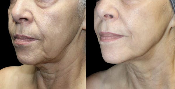 UltraClear® Before & After Gallery - Patient 954347 - Image 1