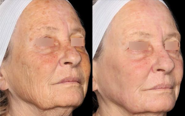 UltraClear® Before & After Gallery - Patient 181886 - Image 1