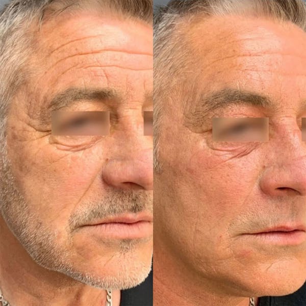 UltraClear® Before & After Gallery - Patient 300713 - Image 1