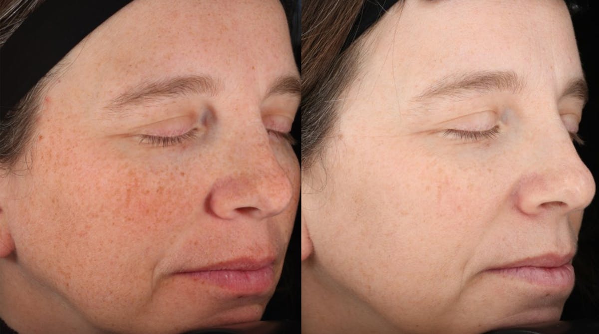 UltraClear® Before & After Gallery - Patient 179338 - Image 1