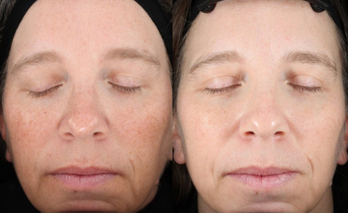 UltraClear® Before & After Gallery - Patient 179338 - Image 2