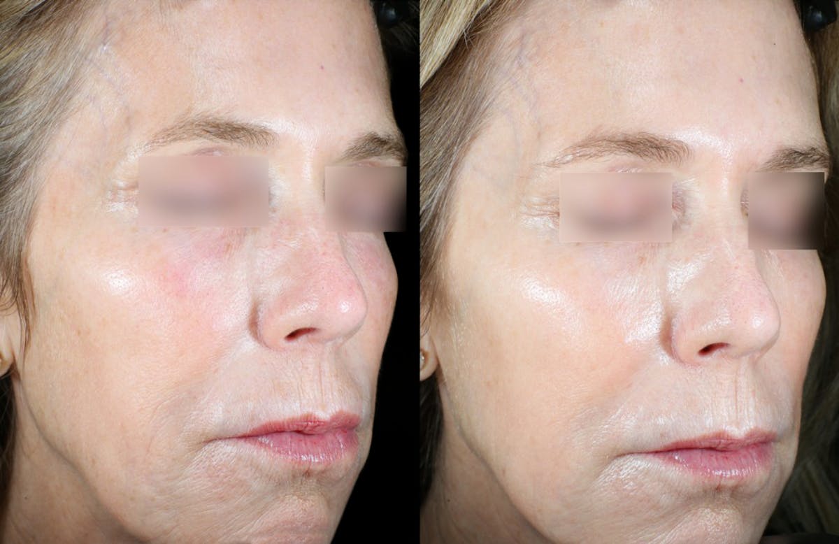 UltraClear® Before & After Gallery - Patient 146206 - Image 1