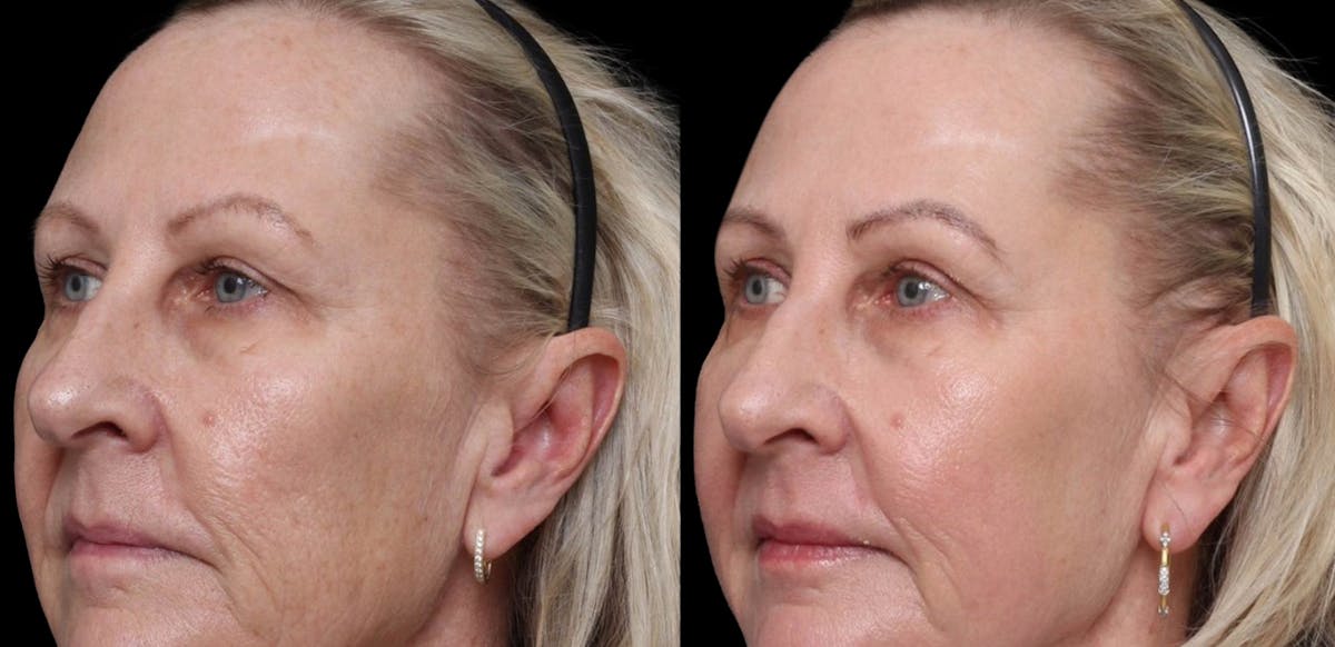 UltraClear® Before & After Gallery - Patient 246567 - Image 1
