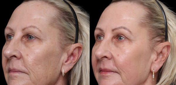 UltraClear® Before & After Gallery - Patient 246567 - Image 1