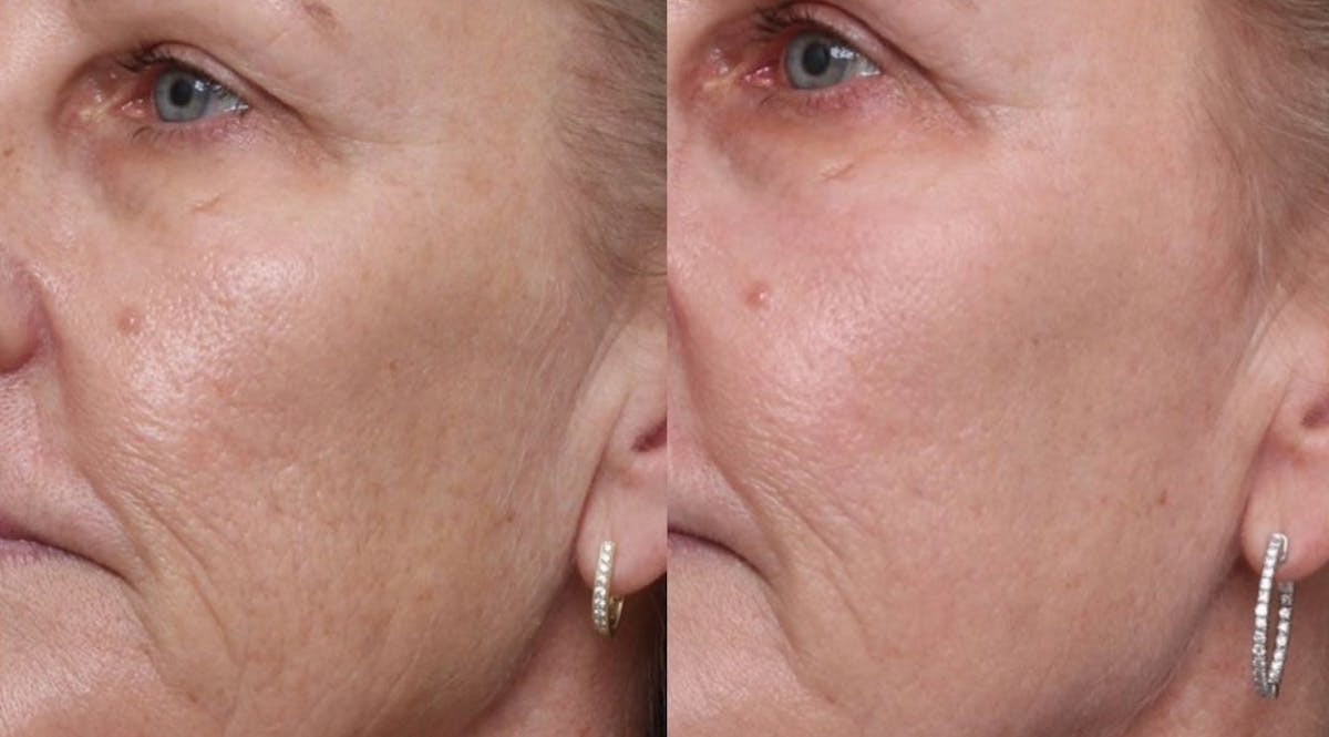 UltraClear® Before & After Gallery - Patient 246567 - Image 2