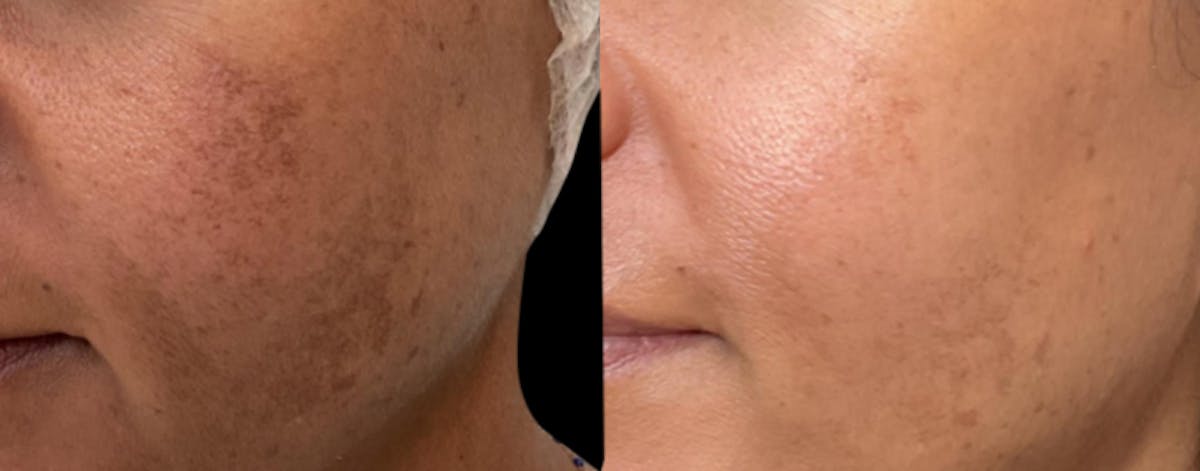 UltraClear® Before & After Gallery - Patient 152491 - Image 1