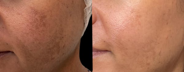 UltraClear® Before & After Gallery - Patient 152491 - Image 1
