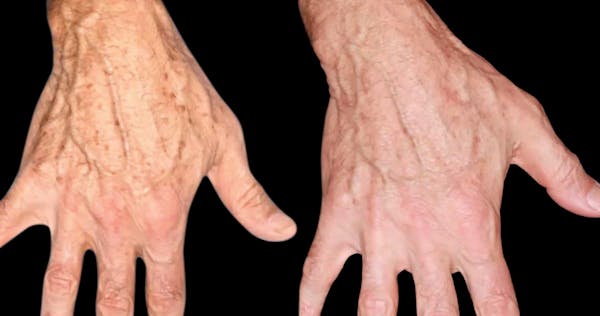 UltraClear® Before & After Gallery - Patient 372750 - Image 1
