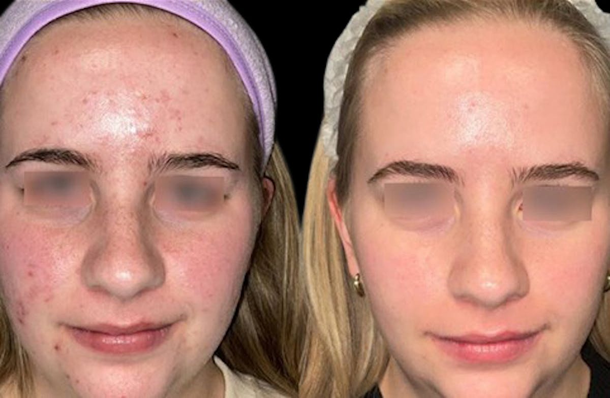 UltraClear® Before & After Gallery - Patient 353520 - Image 1