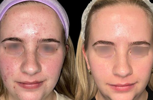 UltraClear® Before & After Gallery - Patient 353520 - Image 1