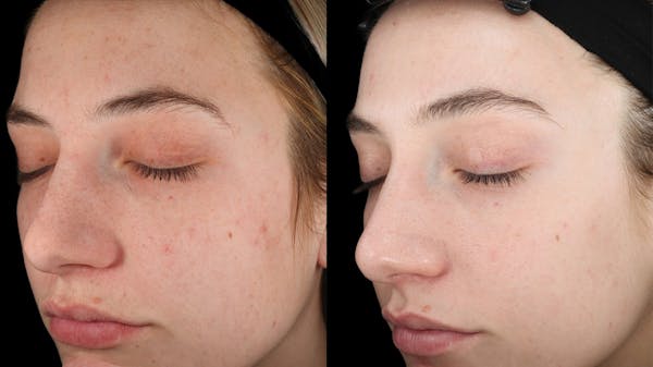UltraClear® Before & After Gallery - Patient 844898 - Image 1