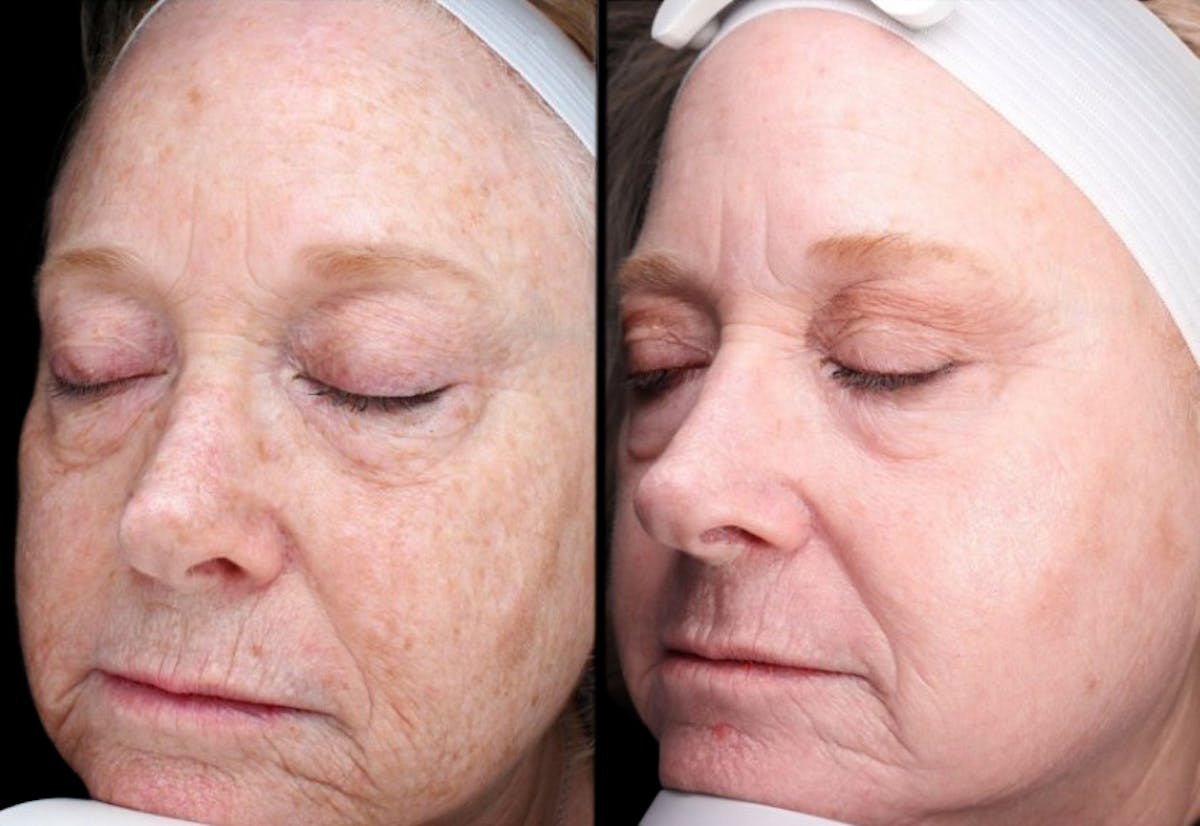 UltraClear® Before & After Gallery - Patient 254738 - Image 1