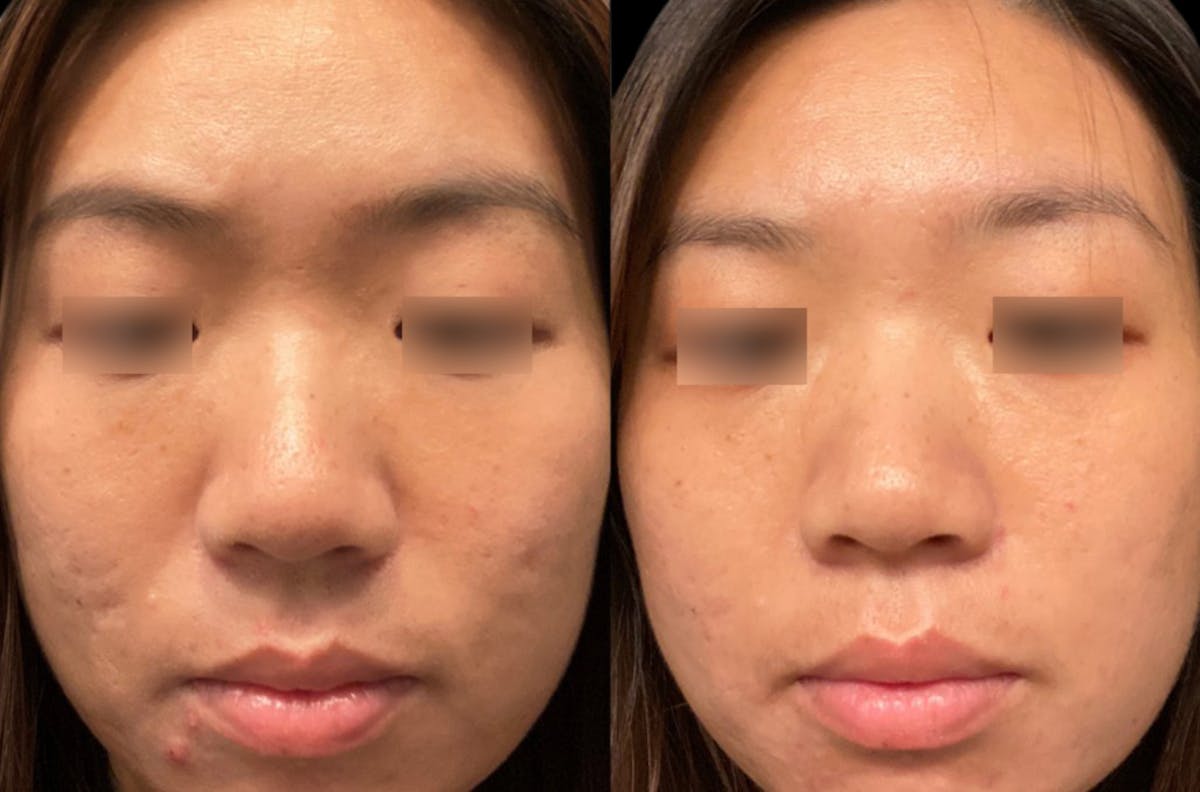 UltraClear® Before & After Gallery - Patient 293941 - Image 1