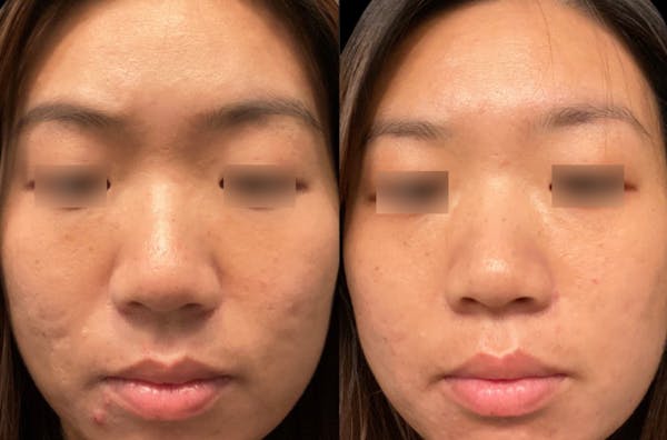 UltraClear® Before & After Gallery - Patient 293941 - Image 1