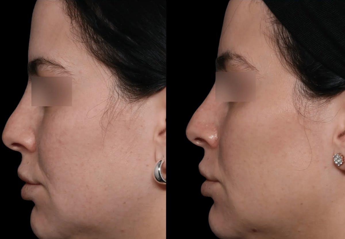 UltraClear® Before & After Gallery - Patient 107110 - Image 1