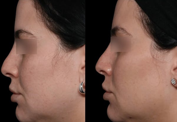UltraClear® Before & After Gallery - Patient 107110 - Image 1