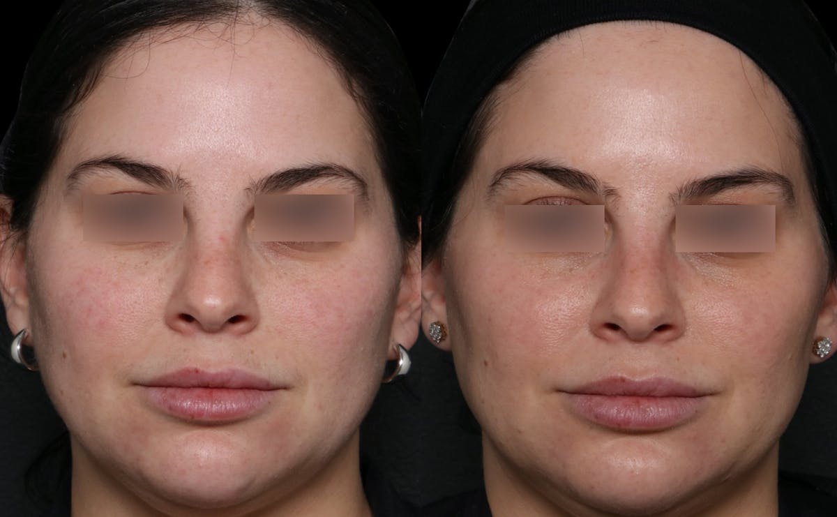 UltraClear® Before & After Gallery - Patient 107110 - Image 2