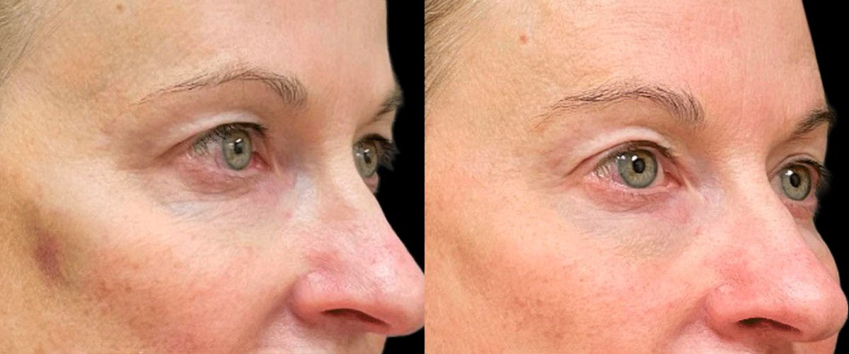 UltraClear® Before & After Gallery - Patient 679606 - Image 1