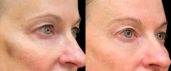 UltraClear® Before & After Gallery - Patient 679606 - Image 1