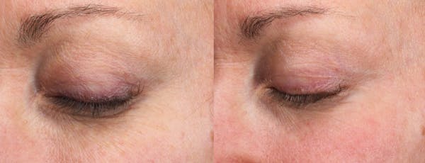 UltraClear® Before & After Gallery - Patient 196544 - Image 1