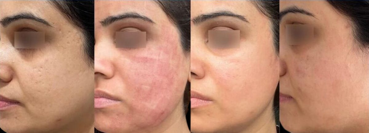 UltraClear® Before & After Gallery - Patient 881122 - Image 1