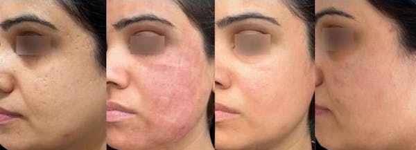 UltraClear® Before & After Gallery - Patient 881122 - Image 1